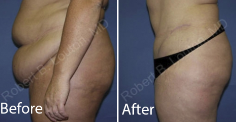 before and after tummy tuck surgery by Dr. Robert Louton | Blair Plastic Surgery