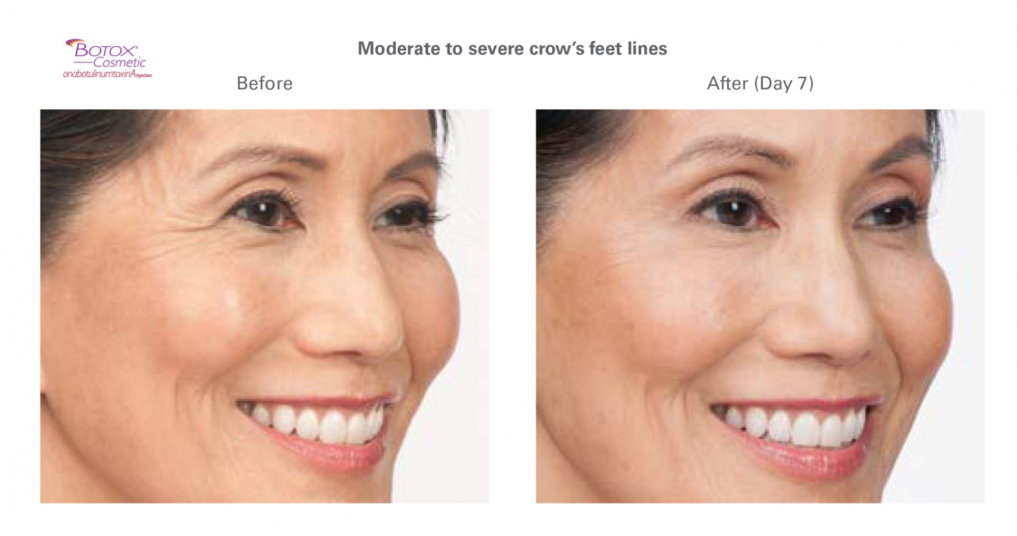 Botox for crow's feet - before and after