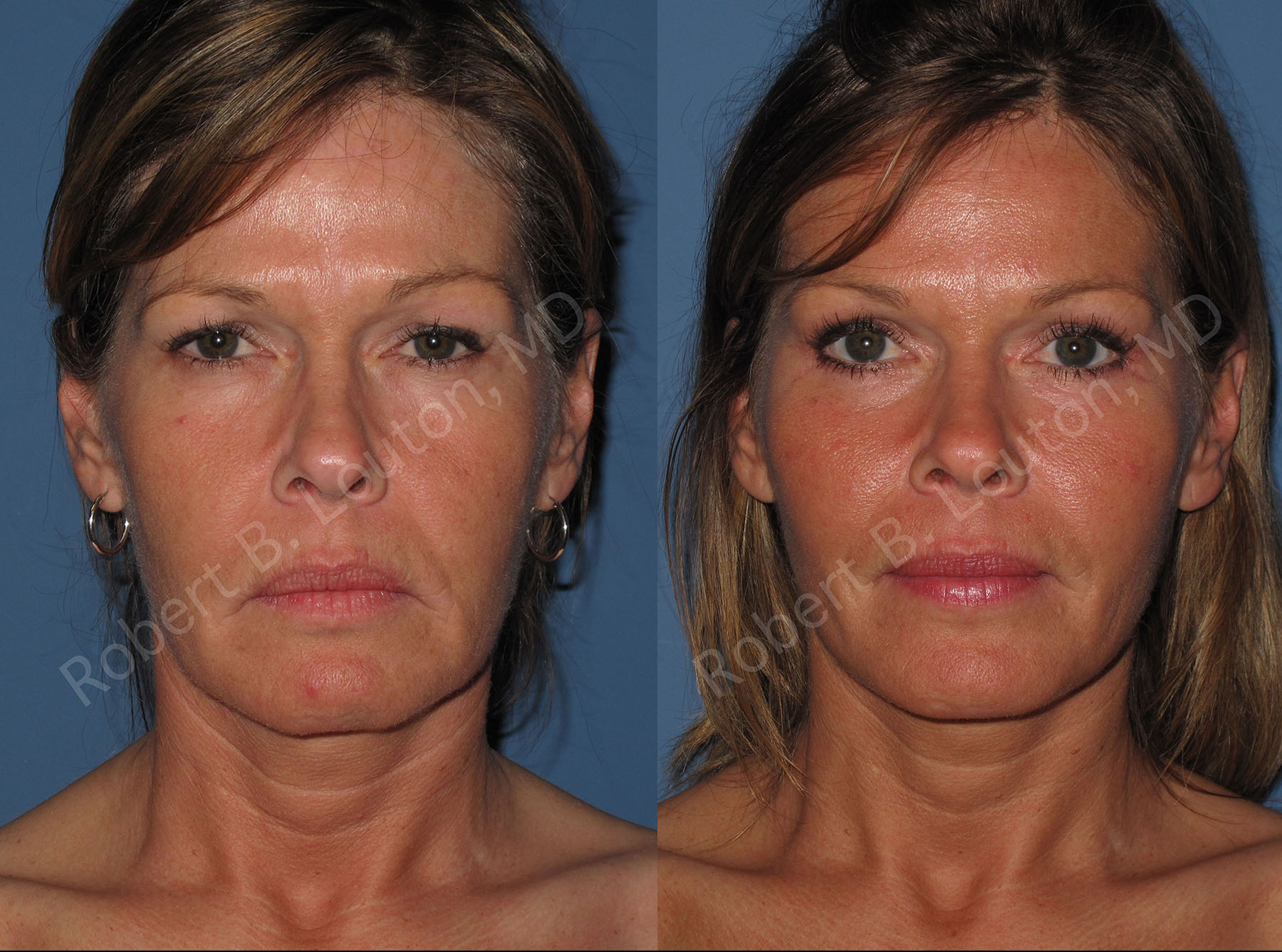 endoscopic facelift before and after - Dr. Robert Louton, Blair Plastic Surgery