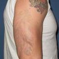 after laser tattoo removal - 5 treatment sessions at Blair Plastic Surgery