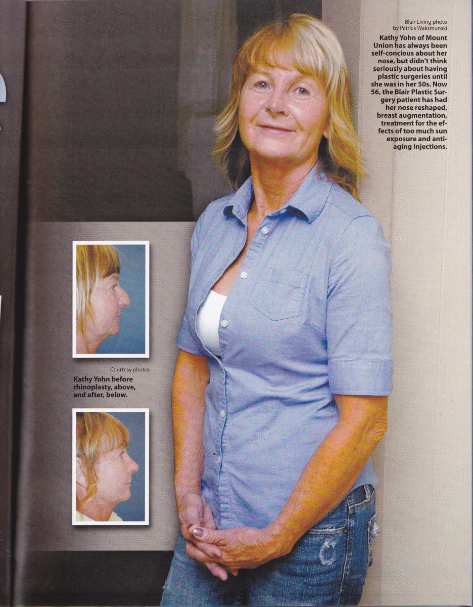 rhinoplasty patient story in Blair Living | Altoona, State College, PA
